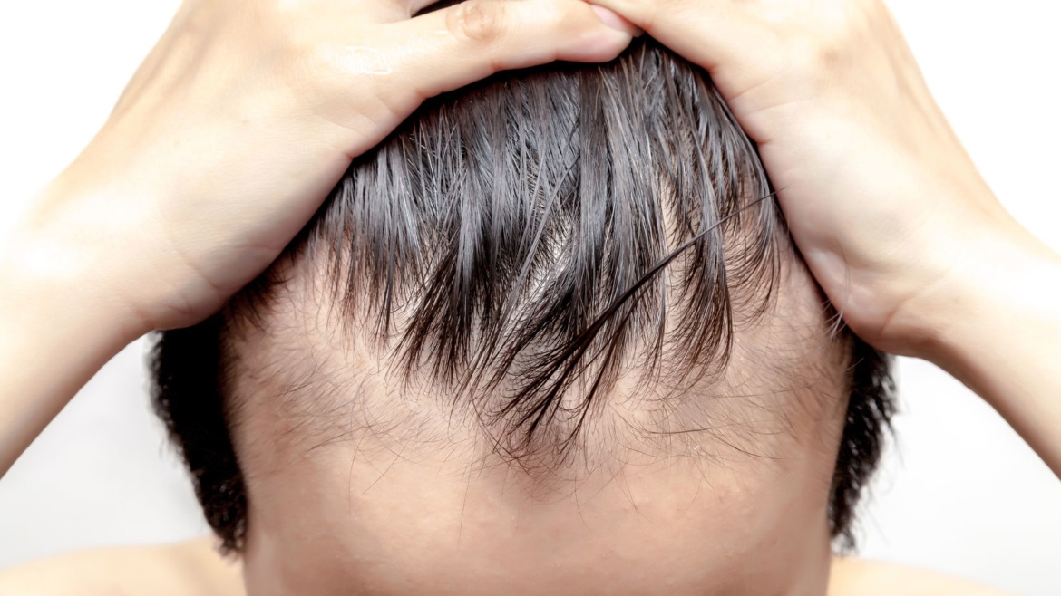 What are Nonsurgical Hair Loss Treatments in Toronto?