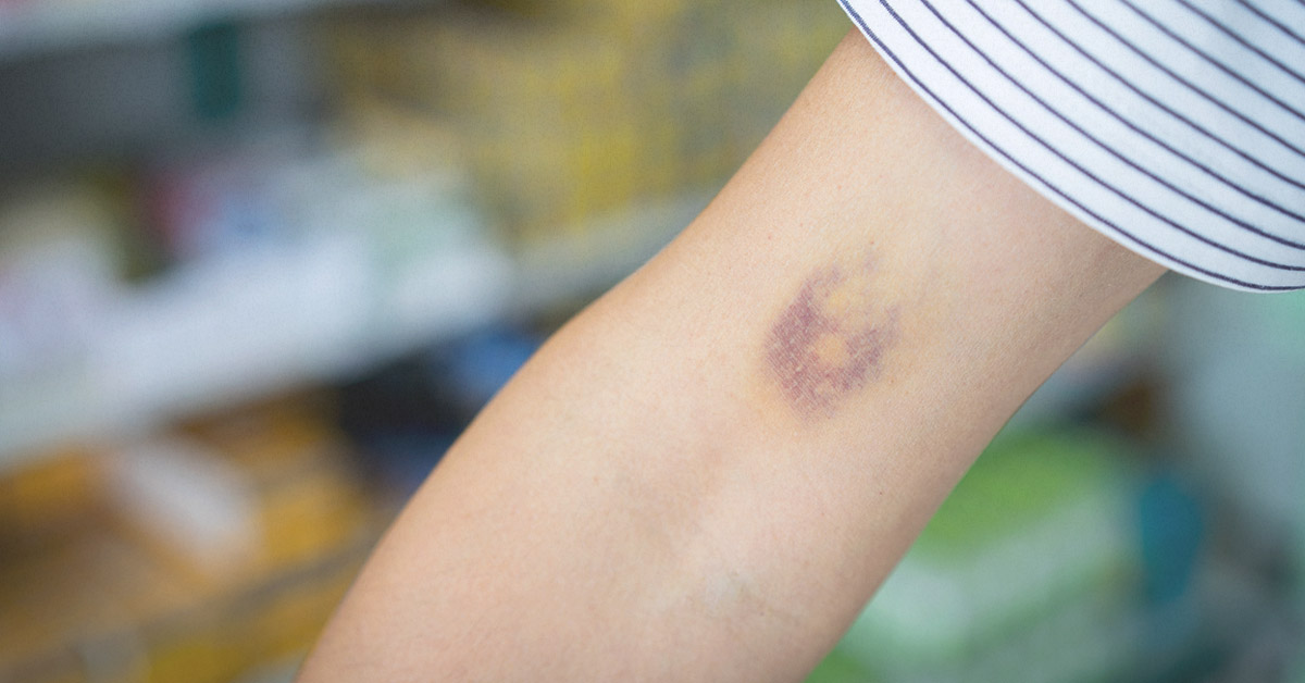 What is the easiest way to get rid of skin bruises?