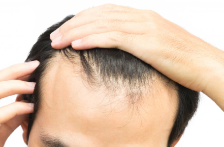 Look for Your Choices With The Best Meds for Baldness
