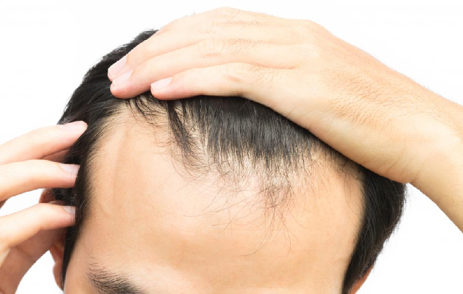 Look for Your Choices With The Best Meds for Baldness