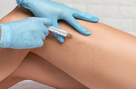 Access Spider Vein Treatment (Sclerotherapy) At Our Medical Spa. New You Wellness Center